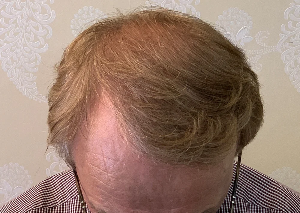 After hair restoration: Male patient underwent FUT procedure of 3042 grafts.