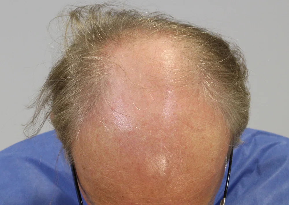 Before hair restoration: Male patient underwent FUT procedure of 3042 grafts.