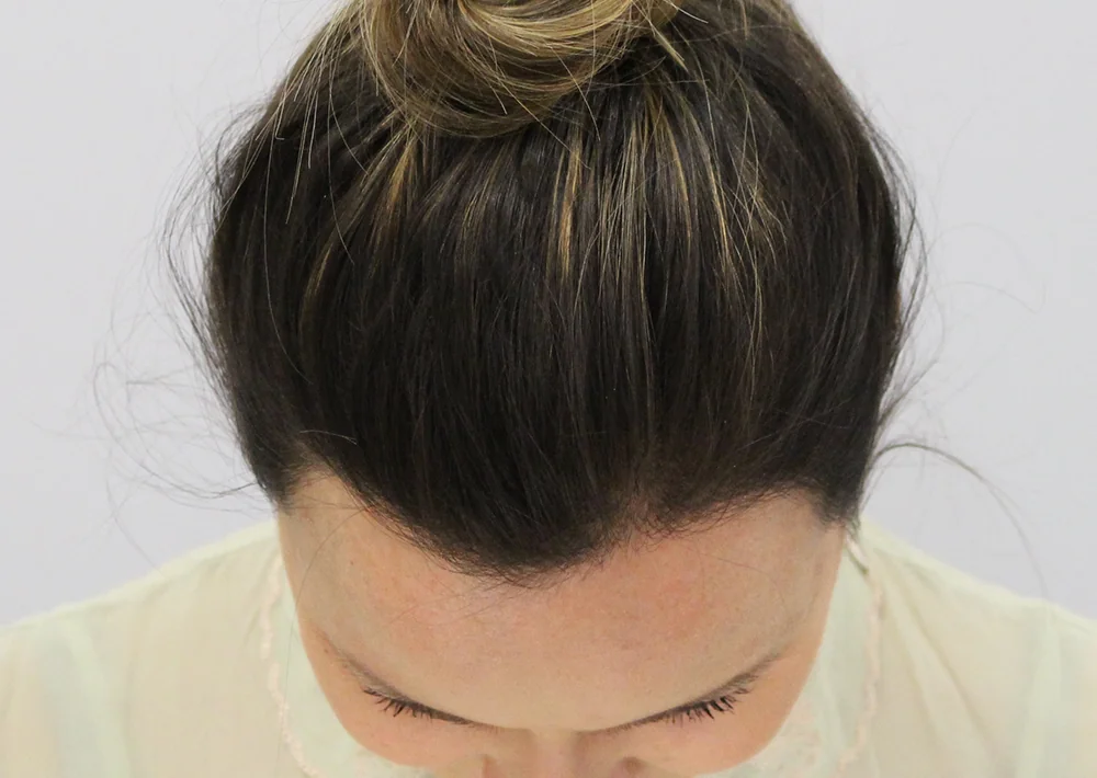 After hair restoration: Female patient underwent FUT procedure of 2150 grafts.