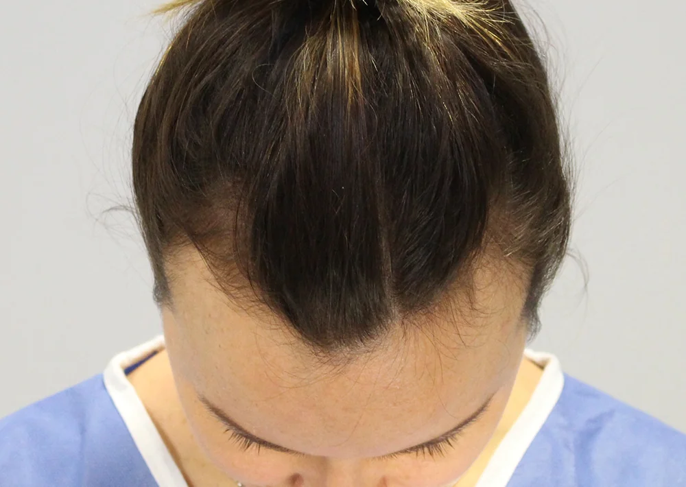 Before hair restoration: Female patient underwent FUT procedure of 2150 grafts.