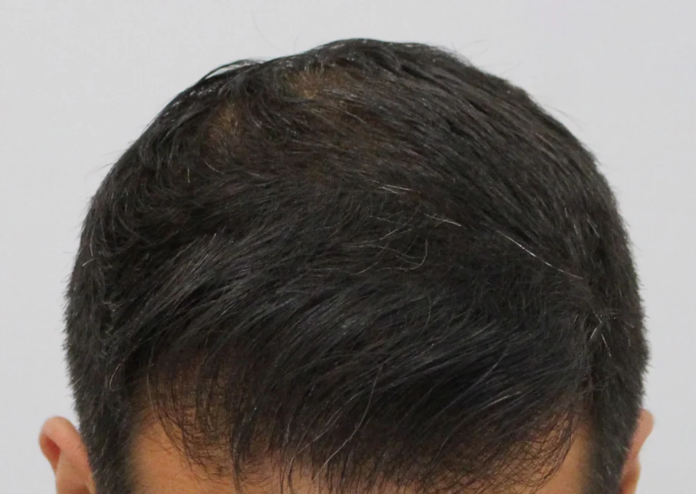 After hair restoration: Male patient underwent PRP non-surgical procedure.