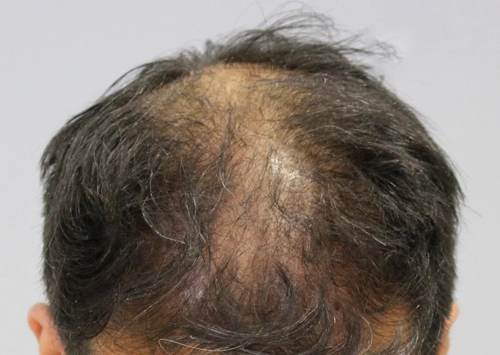 Before hair restoration: Male patient underwent PRP non-surgical procedure.
