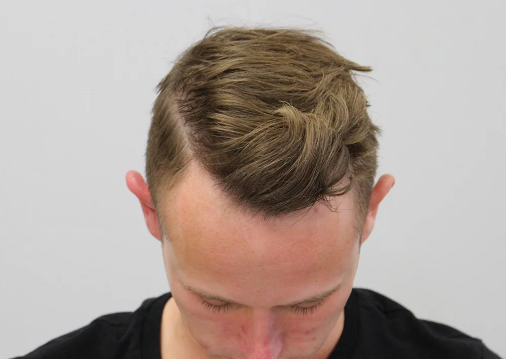 After hair restoration: Male patient underwent FUE procedure of 1192 grafts.