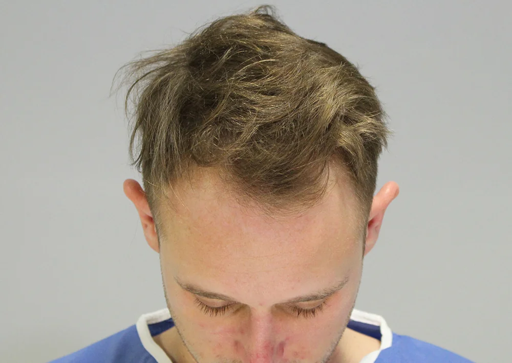 Before hair restoration: Male patient underwent FUE procedure of 1192 grafts.