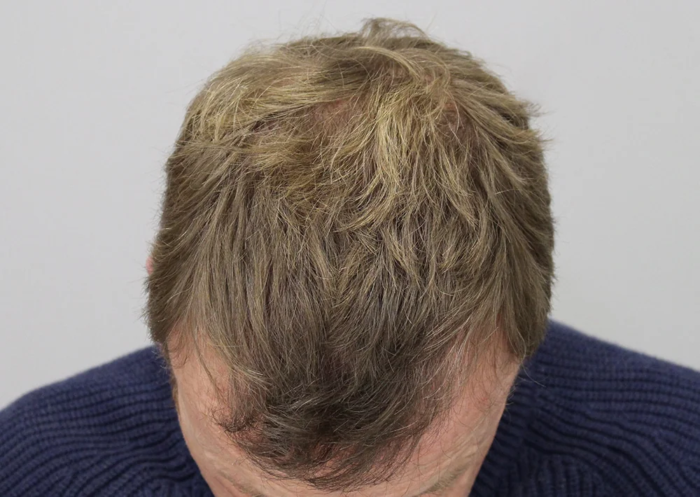 After hair restoration: Male patient underwent FUT procedure of 2607 grafts.