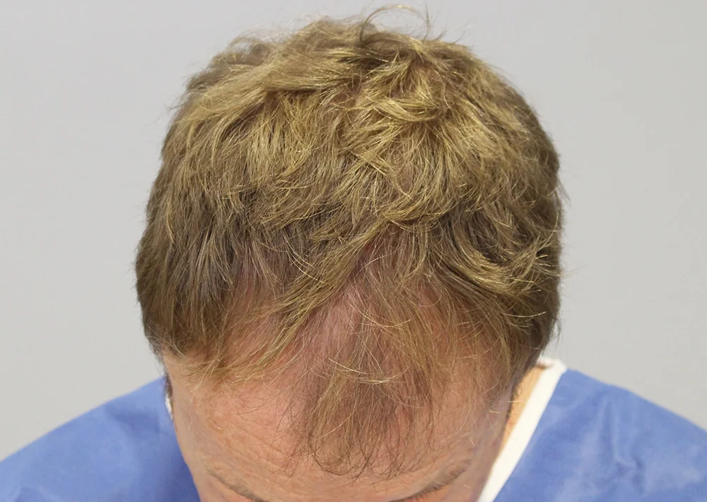 Before hair restoration: Male patient underwent FUT procedure of 2607 grafts.