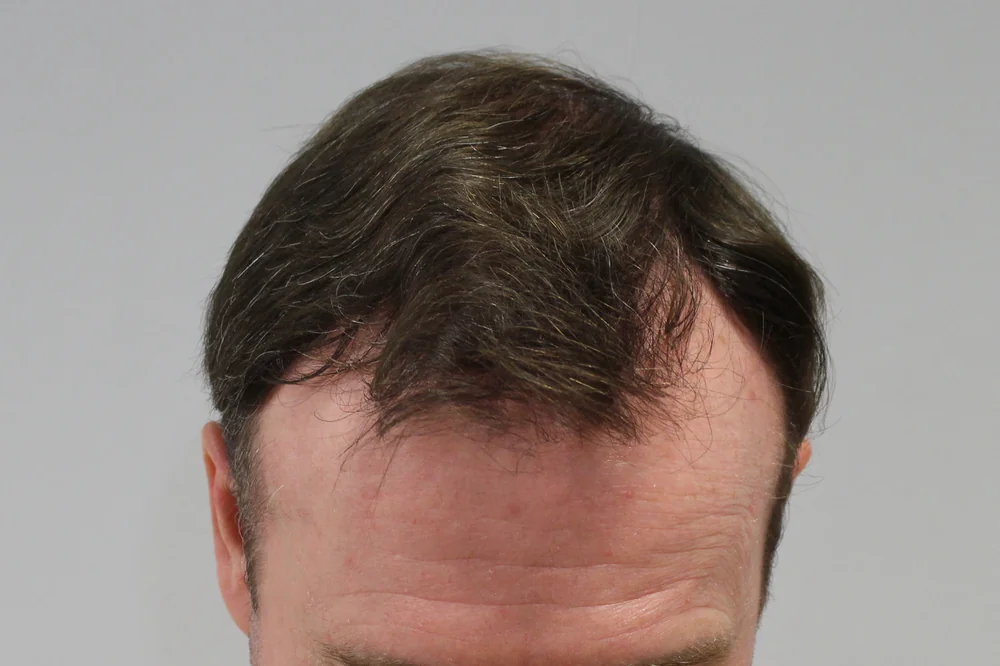 After hair restoration: Male patient underwent FUE procedure of 1831 grafts.