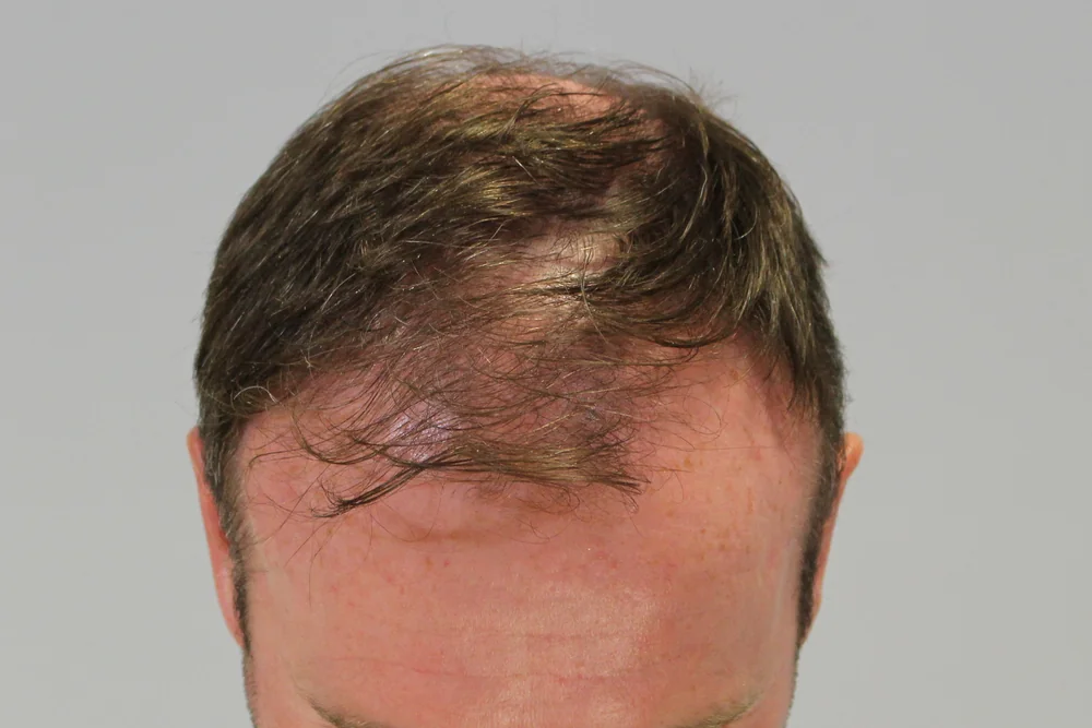 Before hair restoration: Male patient underwent FUE procedure of 1831 grafts.