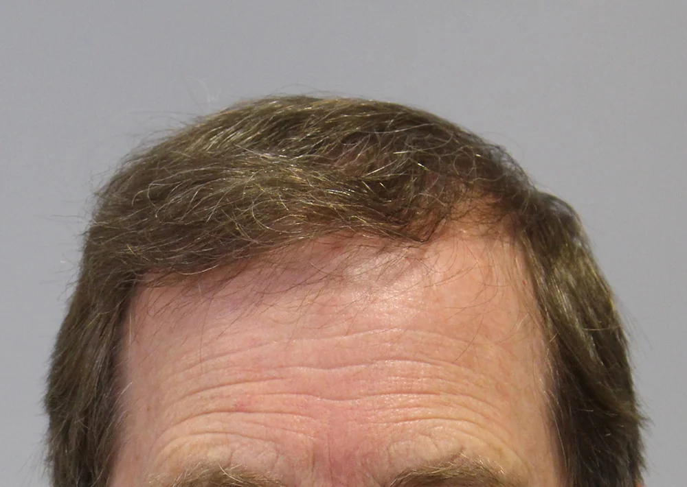 After hair restoration: Male patient underwent FUT procedure of 3654 grafts.