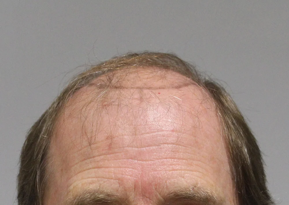 Before hair restoration: Male patient underwent FUT procedure of 3654 grafts.