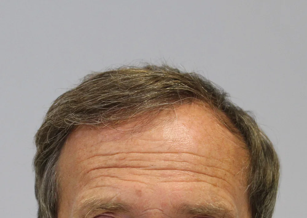 After hair restoration: Male patient underwent FUT procedure of 2693 grafts.