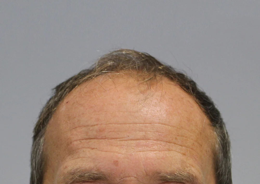 Before hair restoration: Male patient underwent FUT procedure of 2693 grafts.