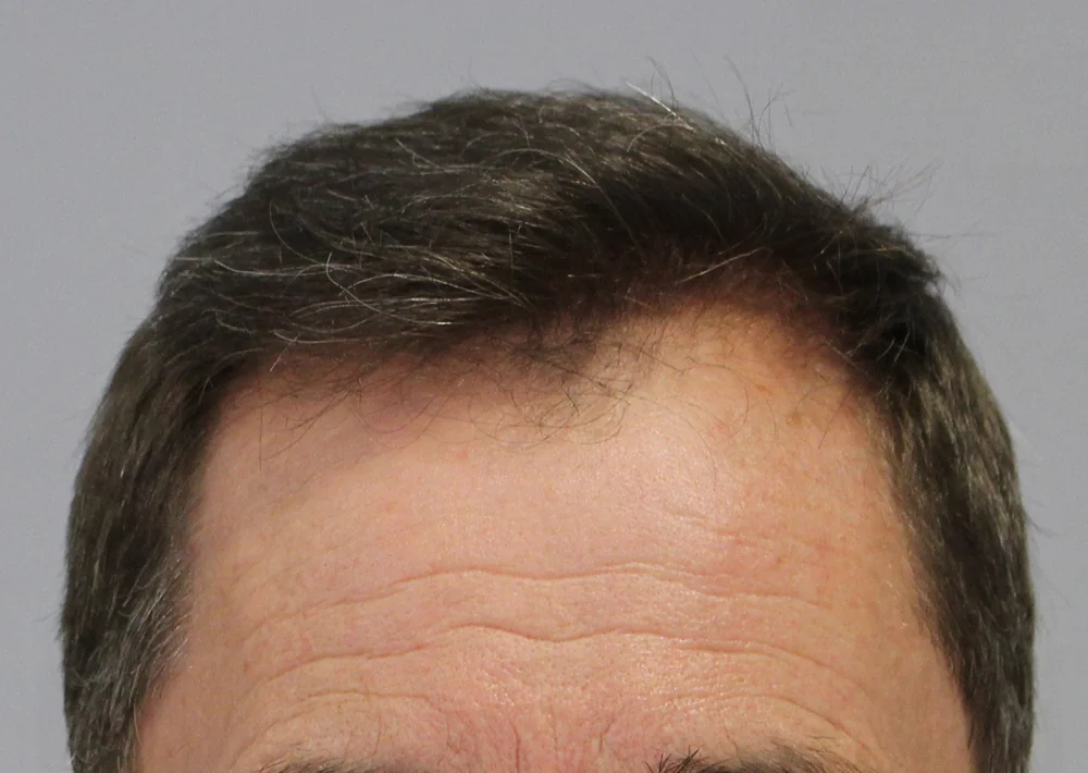 After hair restoration: Male patient underwent FUE procedure of 2173 grafts.
