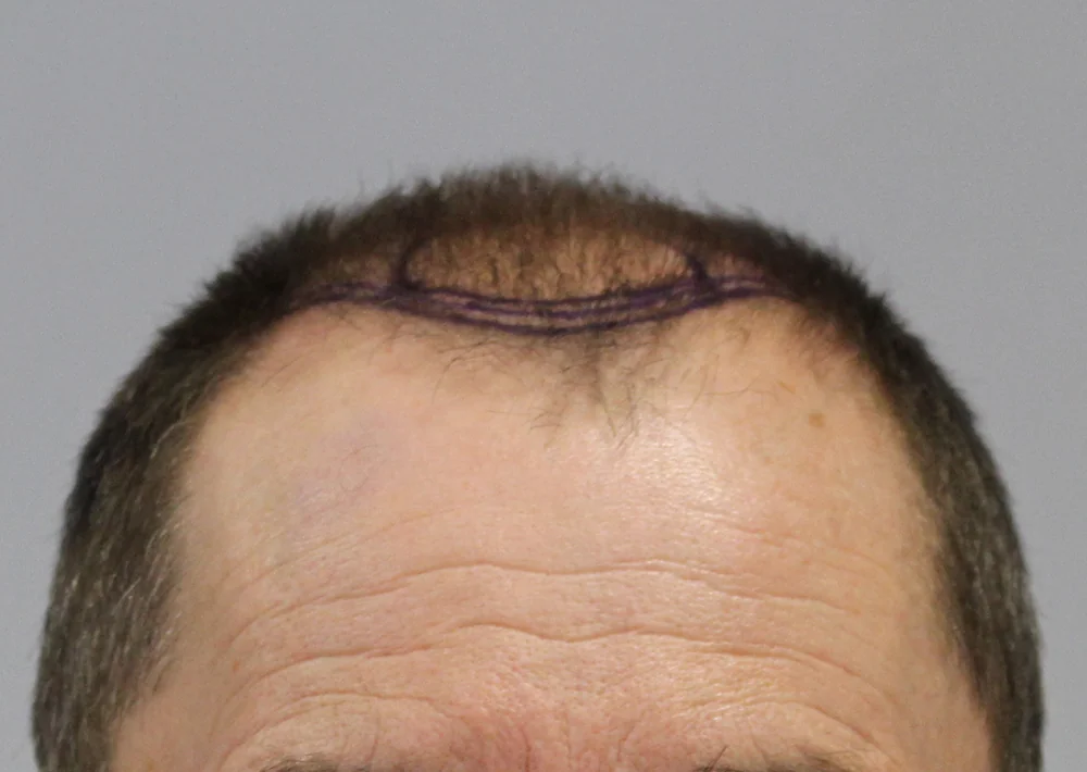 Before hair restoration: Male patient underwent FUE procedure of 2173 grafts.