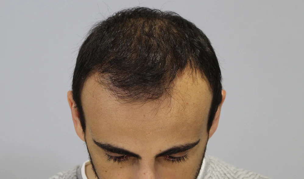 After hair restoration: Male patient underwent FUT procedure of 3439 grafts.