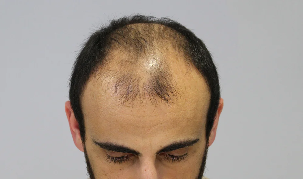 Before hair restoration: Male patient underwent FUT procedure of 3439 grafts.