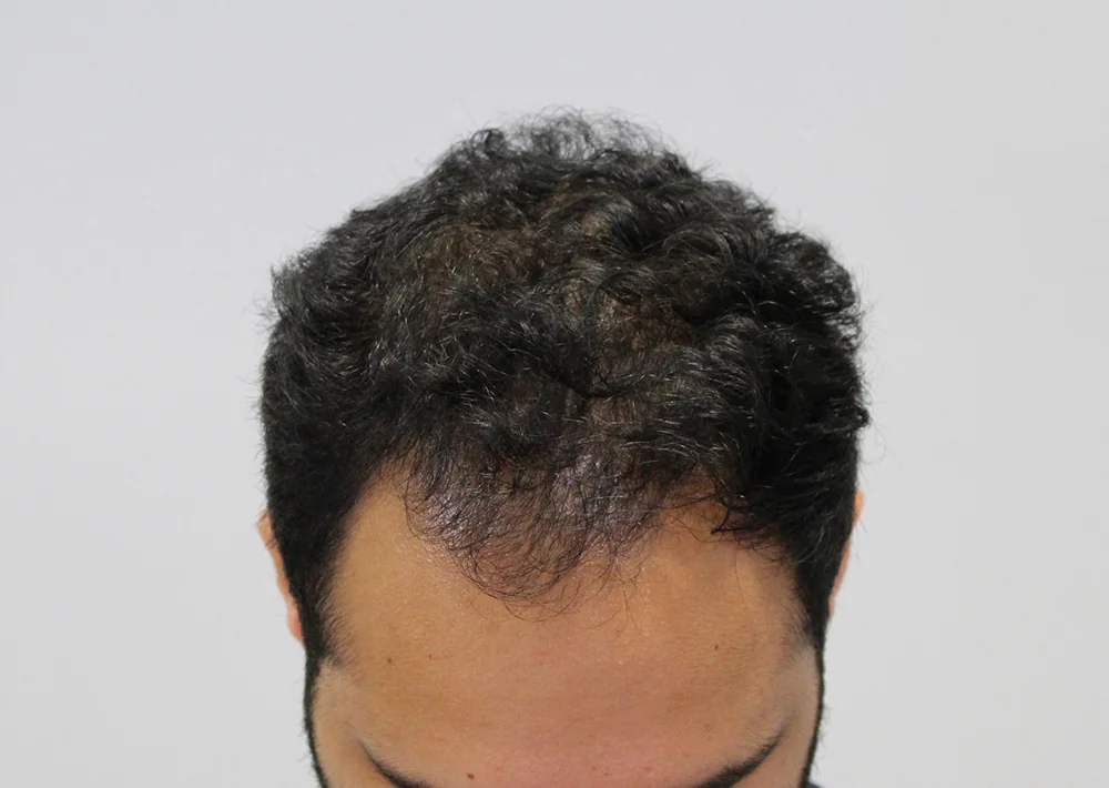 After hair restoration: Male patient underwent PRP non-surgical procedure.