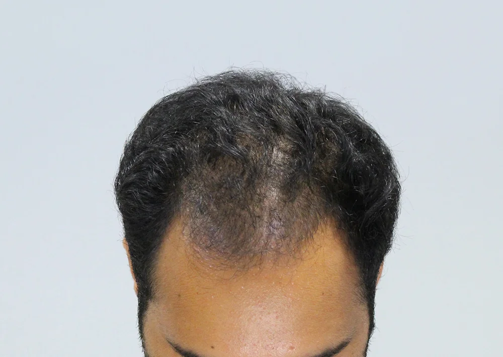 Before hair restoration: Male patient underwent PRP non-surgical procedure.