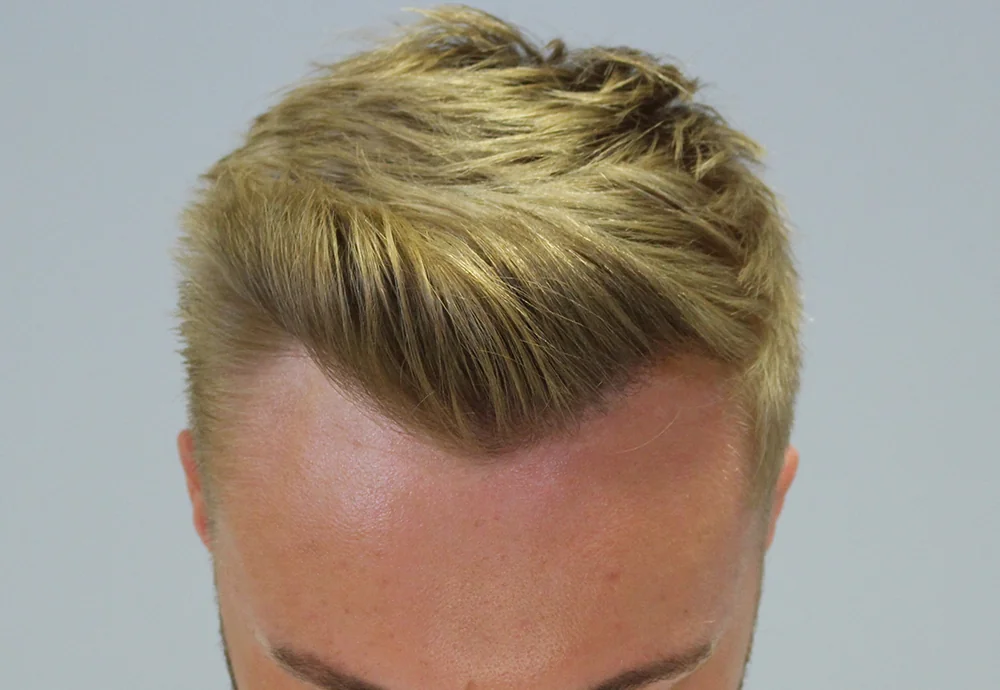 After hair restoration: Male patient underwent FUE procedure of 1074 grafts.