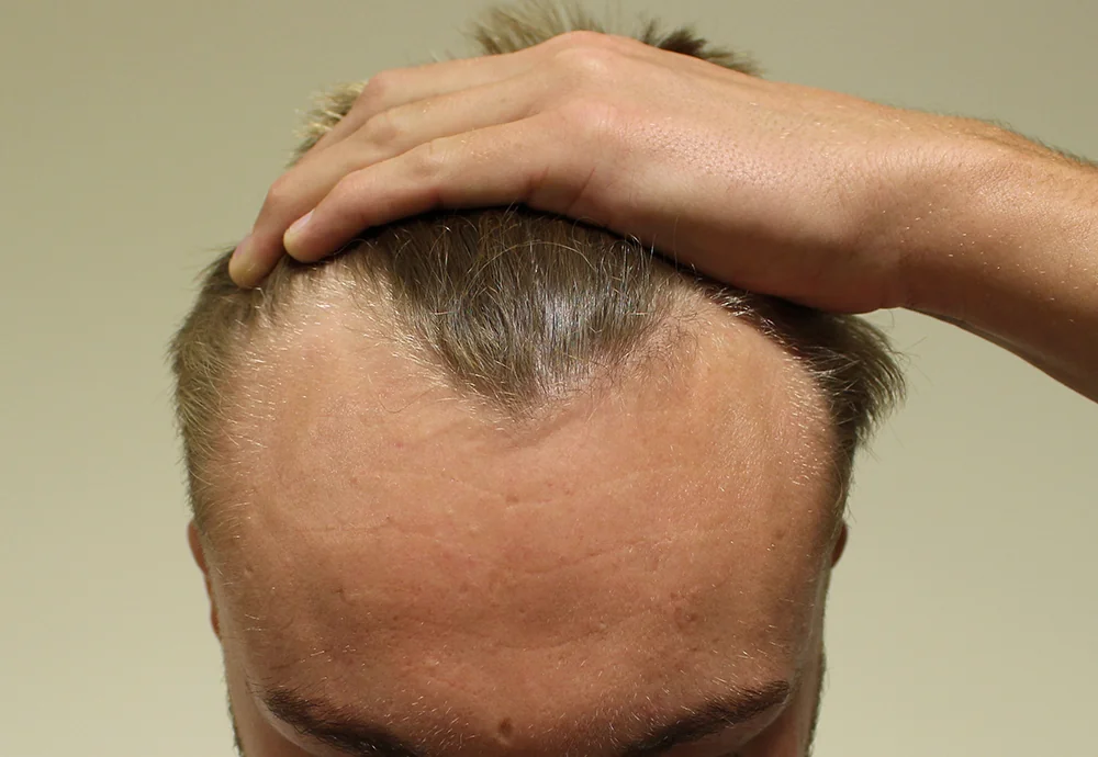 Before hair restoration: Male patient underwent FUE procedure of 1074 grafts.