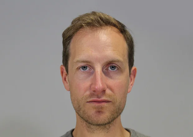 After hair restoration: Male patient underwent FUE procedure of 1895 grafts.