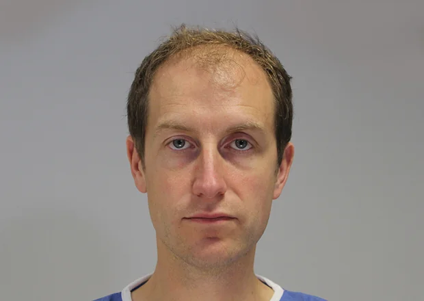 Before hair restoration: Male patient underwent FUE procedure of 1895 grafts.