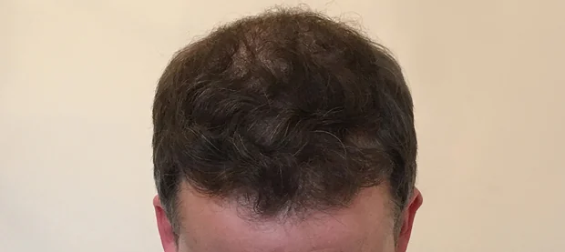After hair restoration: Male patient underwent FUT procedure of 3183 grafts.