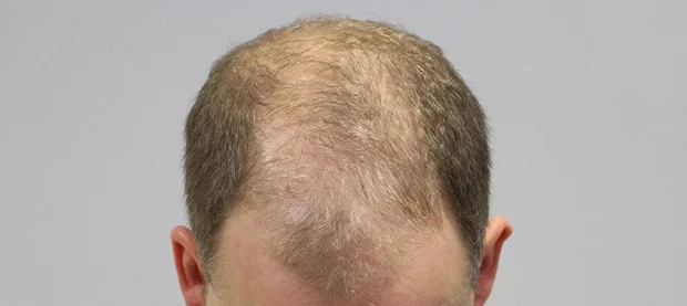 Before hair restoration: Male patient underwent FUT procedure of 3183 grafts.