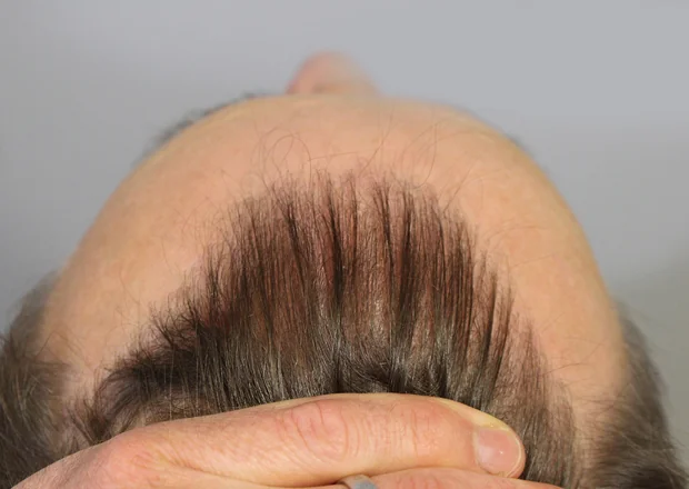After hair restoration: Male patient underwent FUT procedure of 3009 grafts.