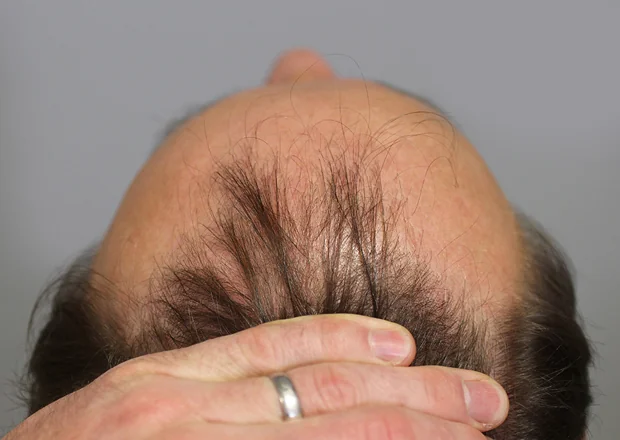 Before hair restoration: Male patient underwent FUT procedure of 3009 grafts.