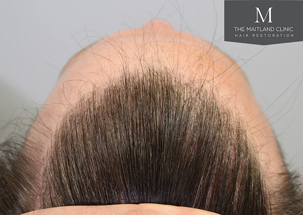 After hair restoration: Male patient underwent FUE procedure of 1660 grafts.