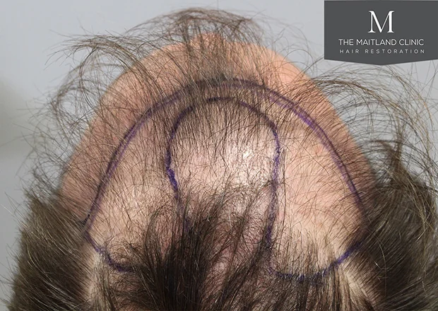 Before hair restoration: Male patient underwent FUE procedure of 1660 grafts.