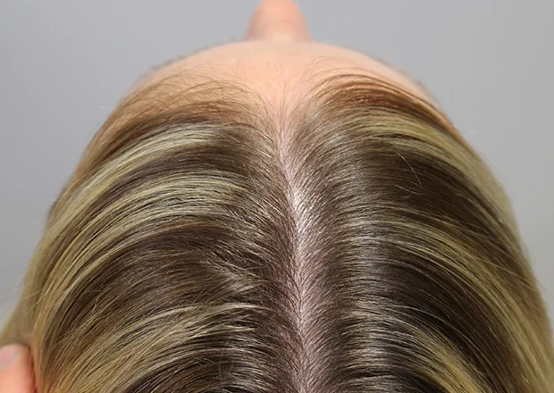 After hair restoration: Female patient underwent PRP non-surgical procedure of.