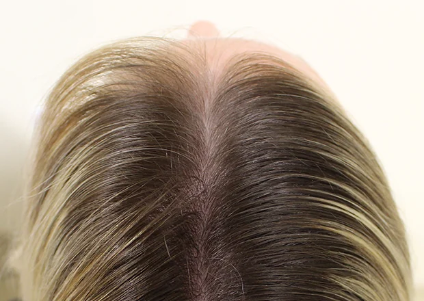 Before hair restoration: Female patient underwent PRP non-surgical procedure of.