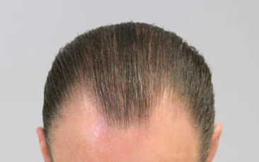 After hair restoration: Male patient underwent FUT procedure of 2816 grafts.
