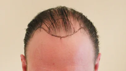 Before hair restoration: Male patient underwent FUT procedure of 2816 grafts.
