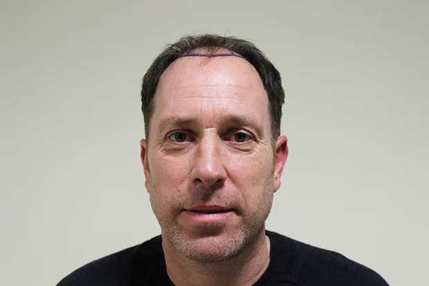 Before hair restoration: Male patient underwent FUT procedure of 3943 grafts.