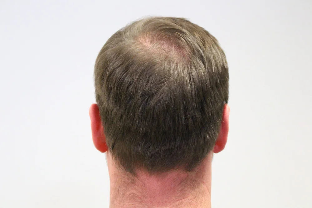 After hair restoration: Male patient underwent FUT procedure of 3155 grafts.