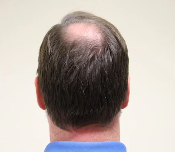 Before hair restoration: Male patient underwent FUT procedure of 3155 grafts.