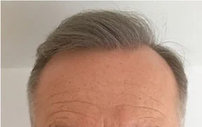 After hair restoration: Male patient underwent FUE procedure of 1500 grafts.