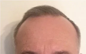 Before hair restoration: Male patient underwent FUE procedure of 1500 grafts.