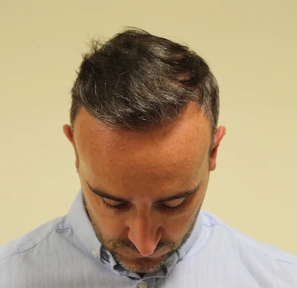 After hair restoration: Male patient underwent FUE procedure of 2162 grafts.