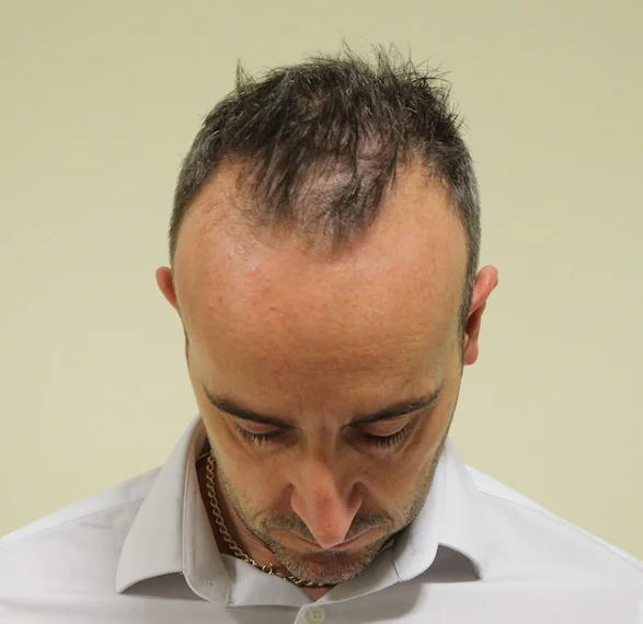 Before hair restoration: Male patient underwent FUE procedure of 2162 grafts.