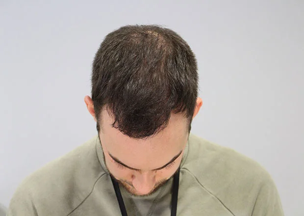 After hair restoration: Male patient underwent FUT procedure of 3464 grafts.