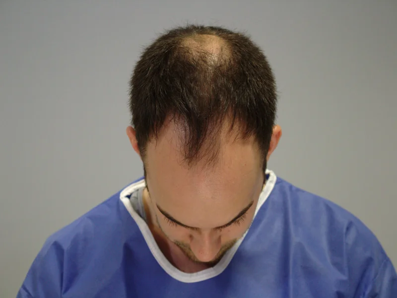 Before hair restoration: Male patient underwent FUT procedure of 3464 grafts.