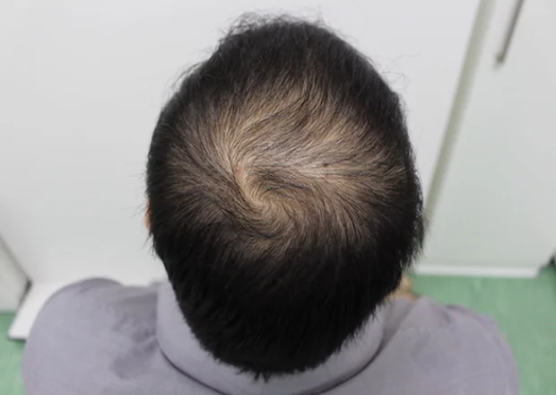 After hair restoration: Male patient underwent PRP non-surgical procedure.