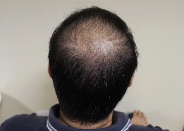 Before hair restoration: Male patient underwent PRP non-surgical procedure.