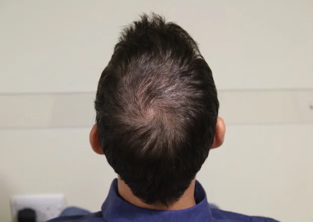 After hair restoration: Male patient underwent FUE procedure of 1349 grafts.