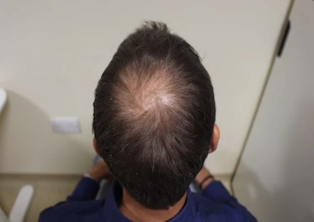 Before hair restoration: Male patient underwent FUE procedure of 1349 grafts.