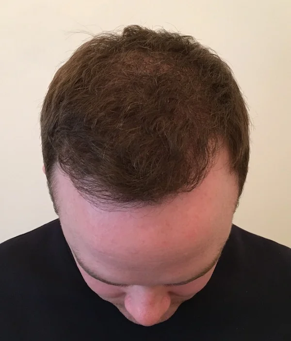 After hair restoration: Male patient underwent FUT procedure of 3057 grafts.